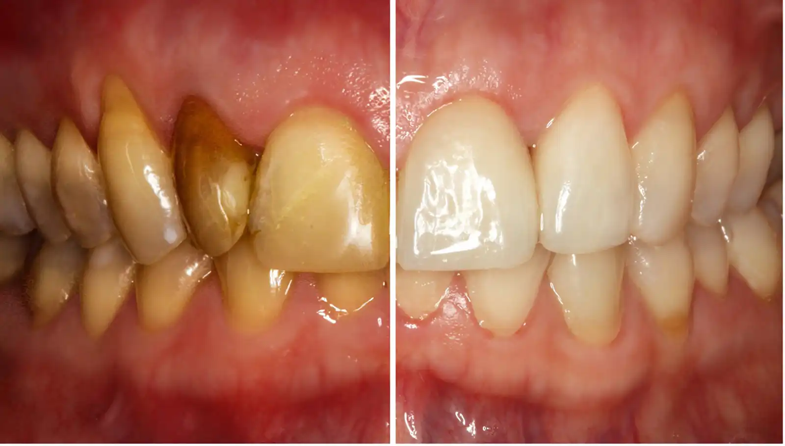 Healthy Teeth and Gums