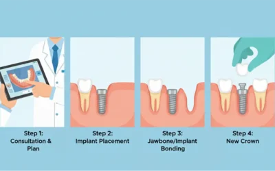 The Dental Implant Procedure: A Step-by-Step Guide from Start to Finish