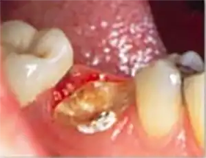 Decayed tooth prior to crown lengthening