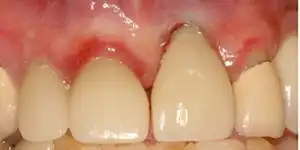 Recession around implant years later