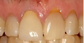 Left front tooth will be replaced with an implant