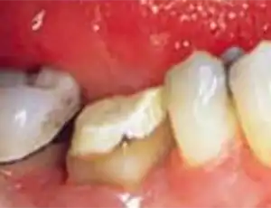 Crown lengthening exposes more of the tooth surface