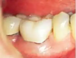 Crown is successfully placed