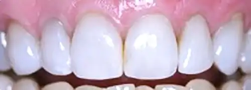 Dental Implants after picture
