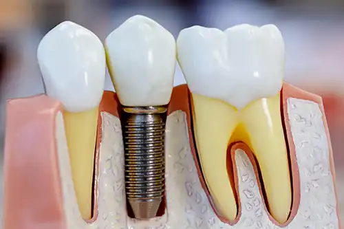 Dental Implants showing 3 teeth