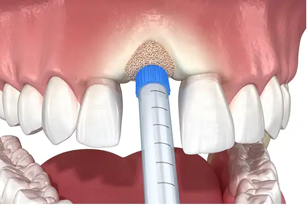 bone grafting