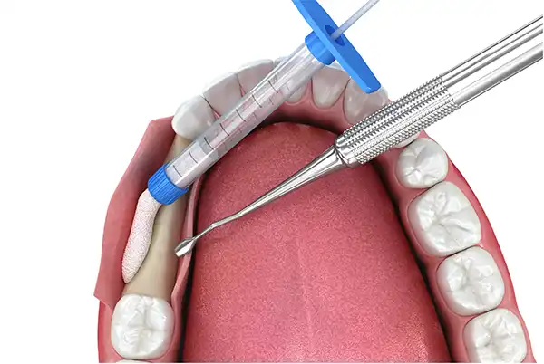 bone grafting