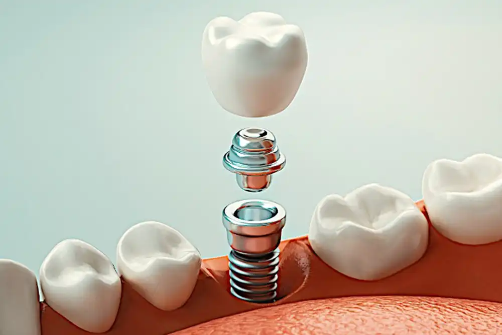 Dental Implants