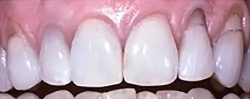 Dental Implants before picture
