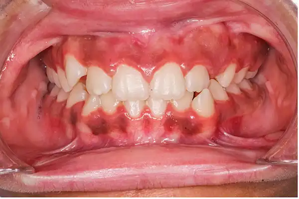 gum grafting after