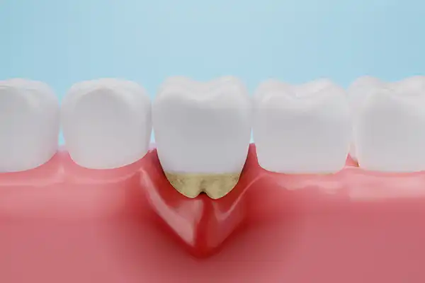 Gum disease Gingival Recession