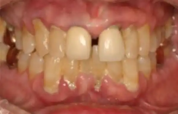 periodontal