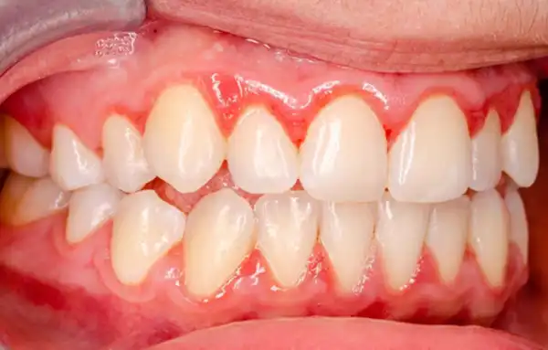 periodontal
