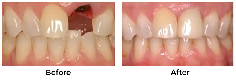 Smile before and after