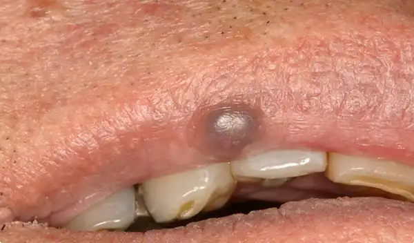 Hemangioma-1-before - Dr. Barry D. Feldner DDS MS PC Actual patient results: A lip hemangioma before and after a single, minimally invasive targeted laser treatment by Dr. Feldner.