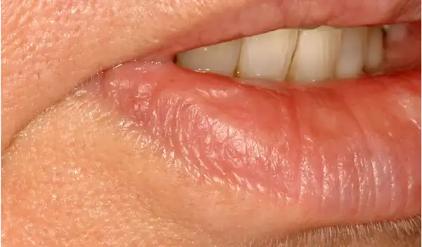 Close-up of a person's lips and teeth, showing dry, wrinkled lips and pink skin around the mouth.