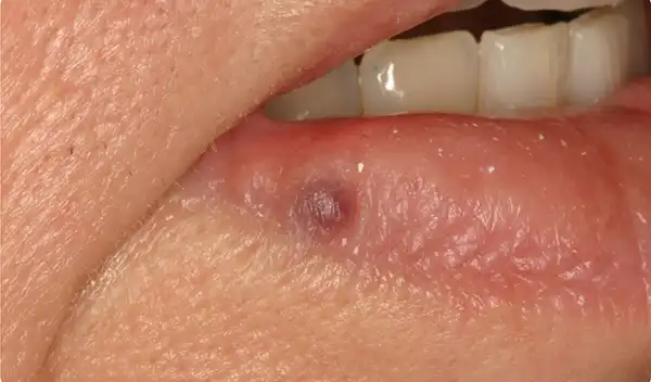 Close-up of a lower lip with a small dark purple bruise-like spot near the inner lip edge.