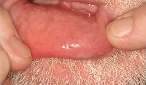 Close-up of pink, irritated inner lip tissue with surrounding beard hairs visible around the mouth.