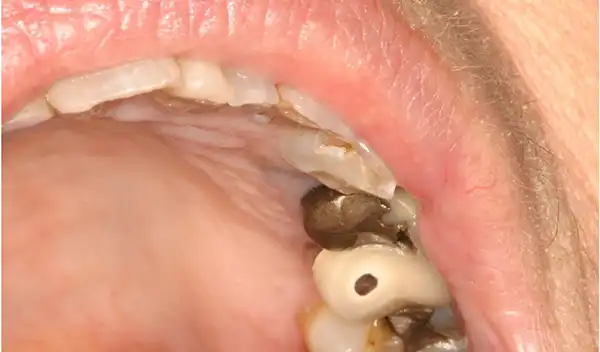 Close-up of the inside of a mouth showing a decayed molar with a dark cavity and adjacent teeth.