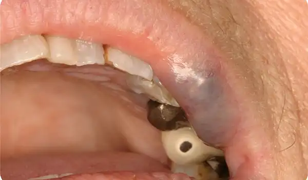Close-up of an open mouth showing a dental implant abutment and surrounding gums in the lower jaw.