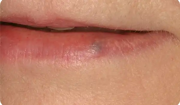Close-up of lips showing a blue-gray bruise on the lower lip.