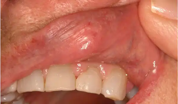 Close-up of the inside of the upper lip with red, irritated mucosa and chipped front teeth.