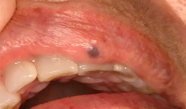 Close-up of a mouth with red, irritated upper lip showing small pimples and a tiny dark spot; teeth are visible inside the mouth.