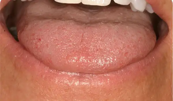 Close-up of a person's mouth with tongue visible and resting over the lower teeth; upper teeth are at the top of the frame.