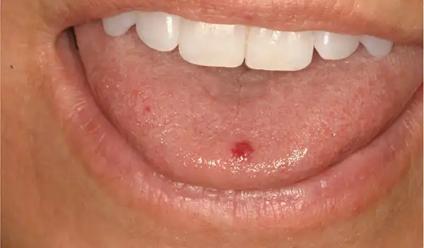Close-up of a mouth showing a small red ulcer on the inner lower lip/cheek area near the center of the mouth.