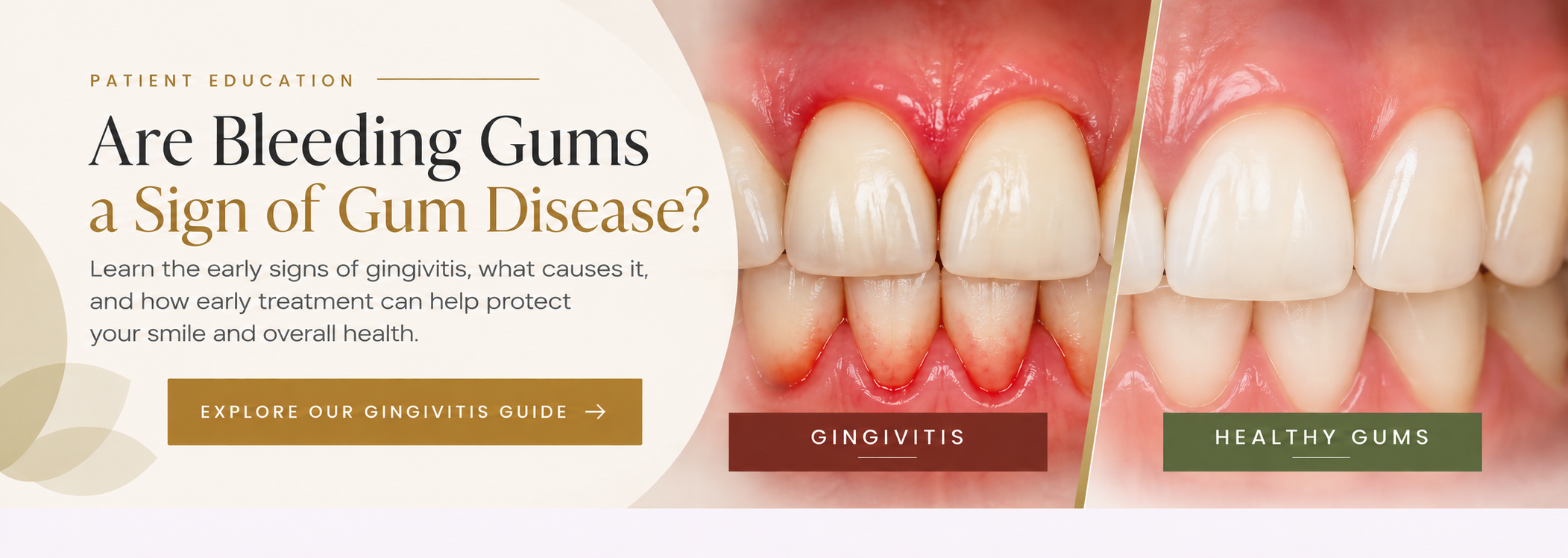Gingivitis patient education guide from Dr. Barry Feldner, periodontist in Kearney, Nebraska.